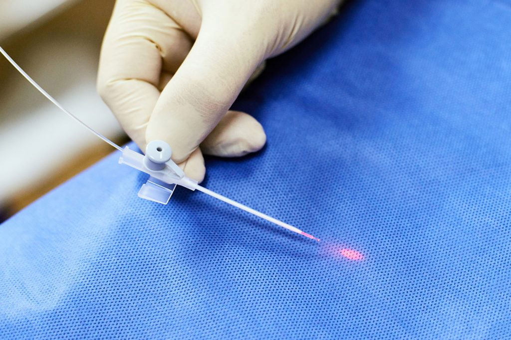 lekarz Jacek Konczalski laserowe usuwanie żylaków